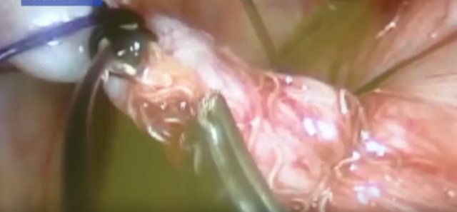 U toku operacije slepog creva lekari u stomaku pronašli crve